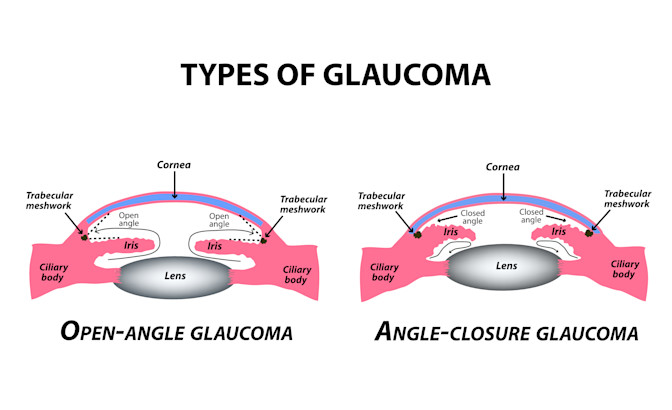Glaucoma Image