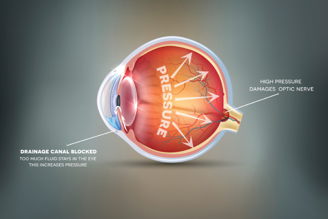 Glaucoma Image - 672